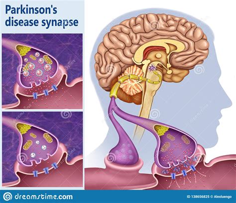 A Dopamina Jogo De Parkinsons